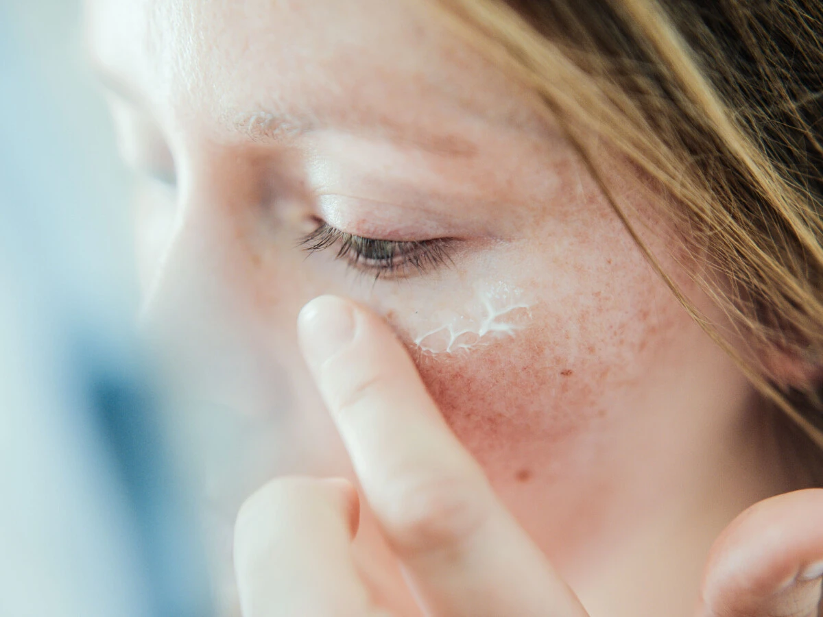 Sonnenbrand Gesicht Frau trägt Pflege im Gesicht nach Sonnenbrand auf